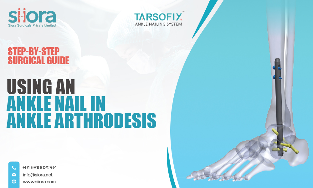 Using an Ankle Nail in Ankle Arthrodesis